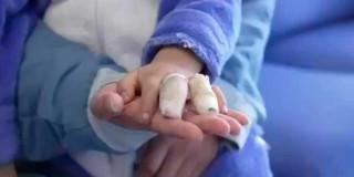 Foto de un niño afectado en su mano por quemaduras con pólvora.