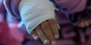 Niño indígena sufrió quemadura con liquido Universidad Nacional Bogotá